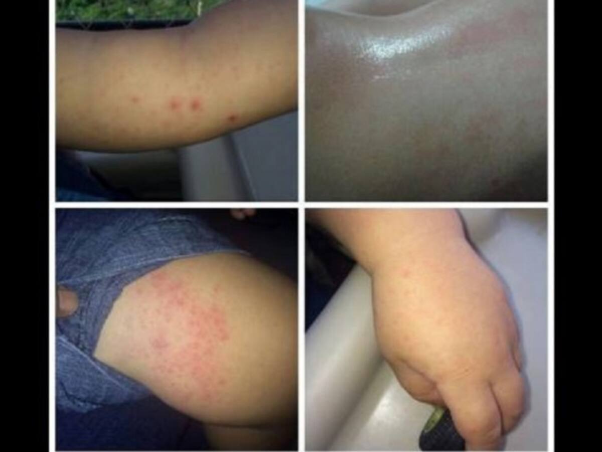 A más de 6.000 ascienden los casos de Zika en Norte De Santander