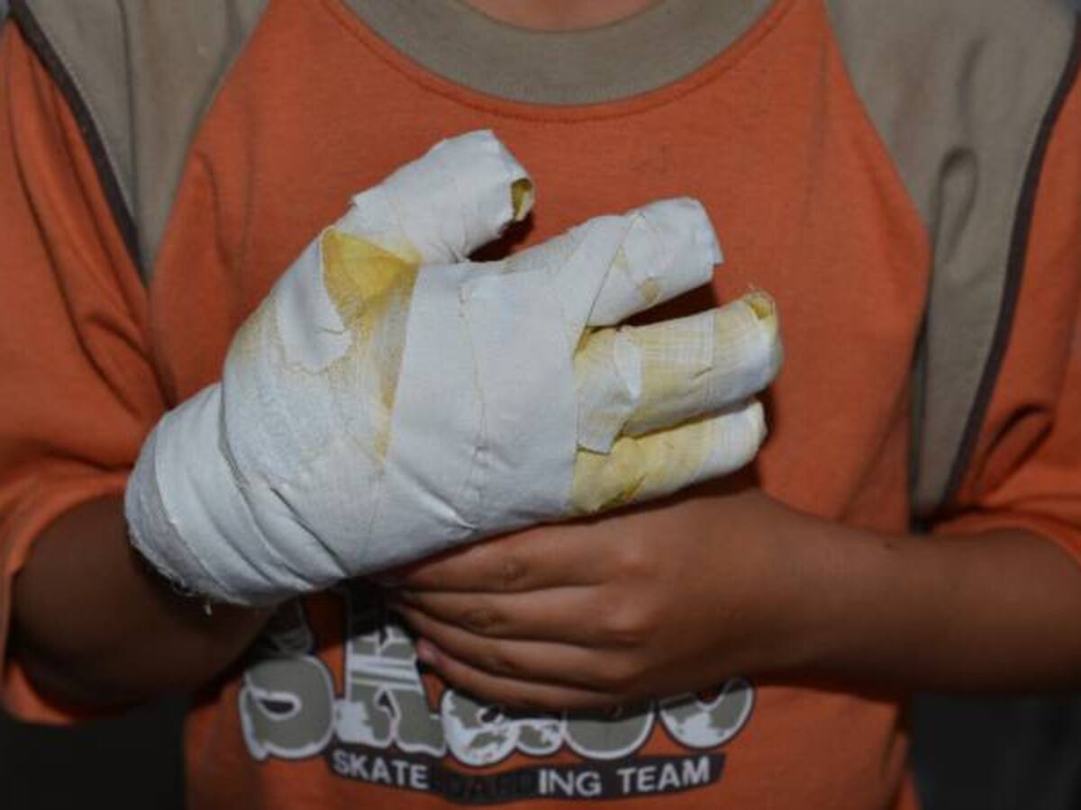 Se eleva a 152 el número de niños quemados con pólvora