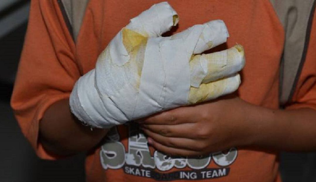 El menor fue internado en la unidad de cuidado intensivo pediátrico del HUV, donde tuvo que ser intubado.