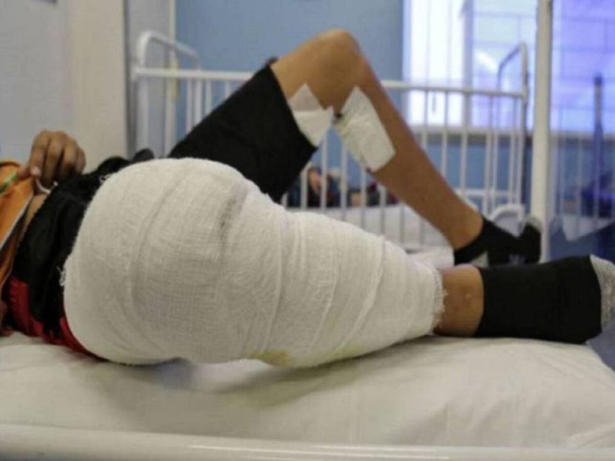 Expertos alertan sobre del riesgo de quemados y dan recomendaciones