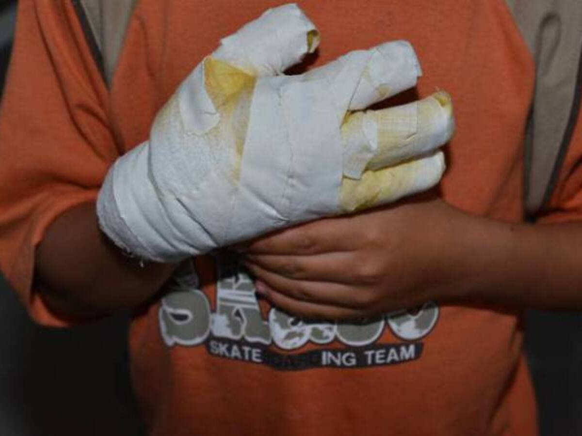 Un niño de 4 años sufrió una lesión con pólvora en uno de sus ojos en Ibagué