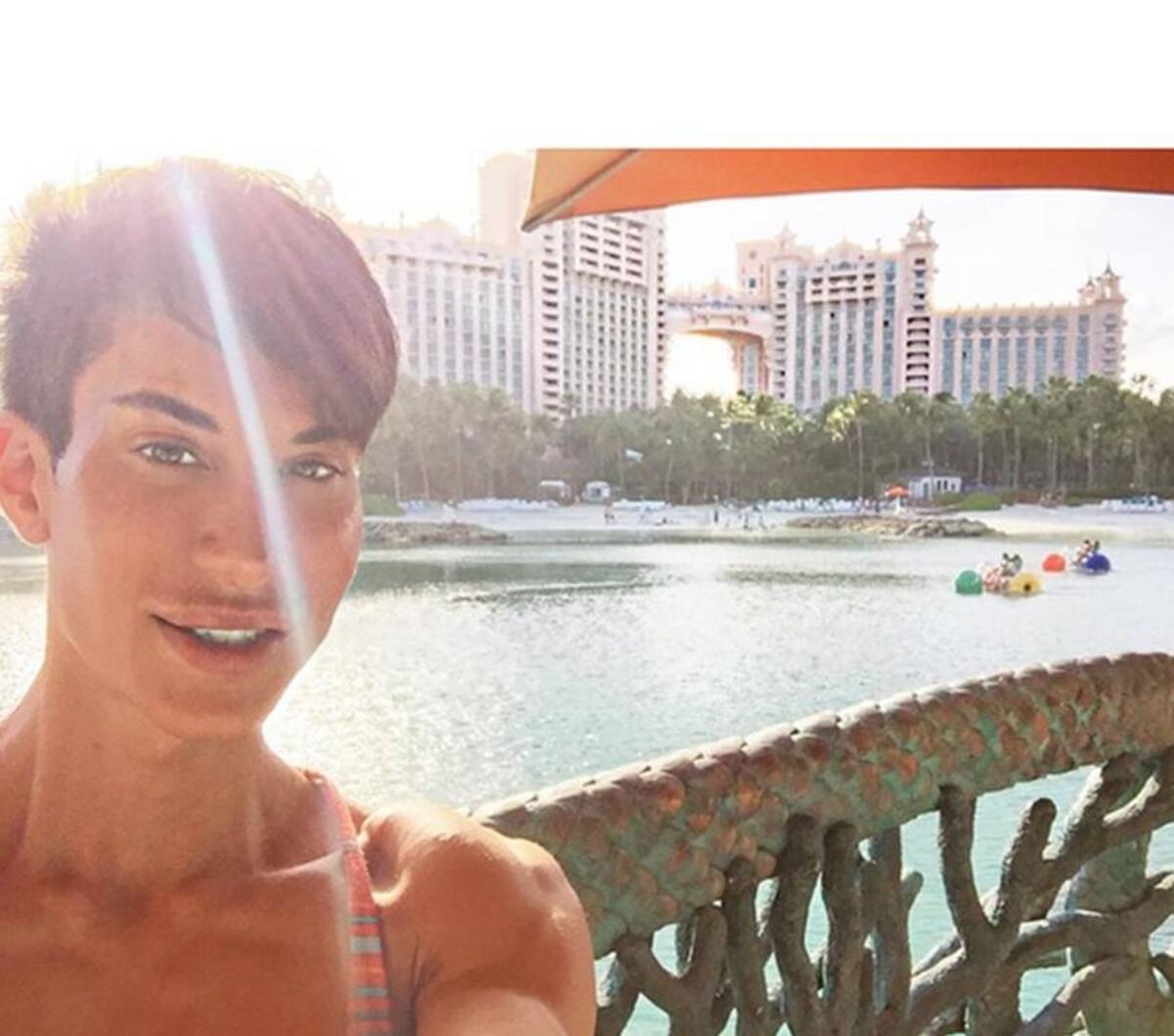Justin Jedlica se operó para remover tres venas de su frente, intervención que lo pudo dejar ciego. Fotos: Instagram.