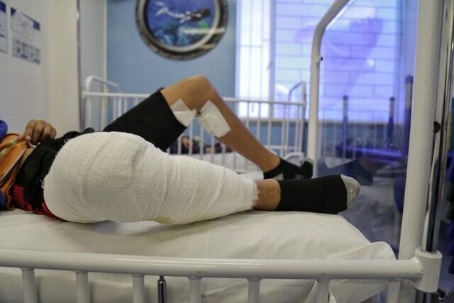 Imagen de referencia de quemados por pólvora / Foto: Colprensa