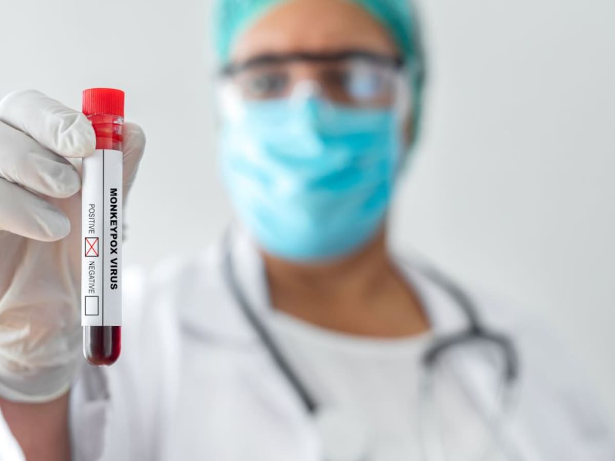 OMS eleva a más de 9.200 los casos de viruela del mono en todo el mundo