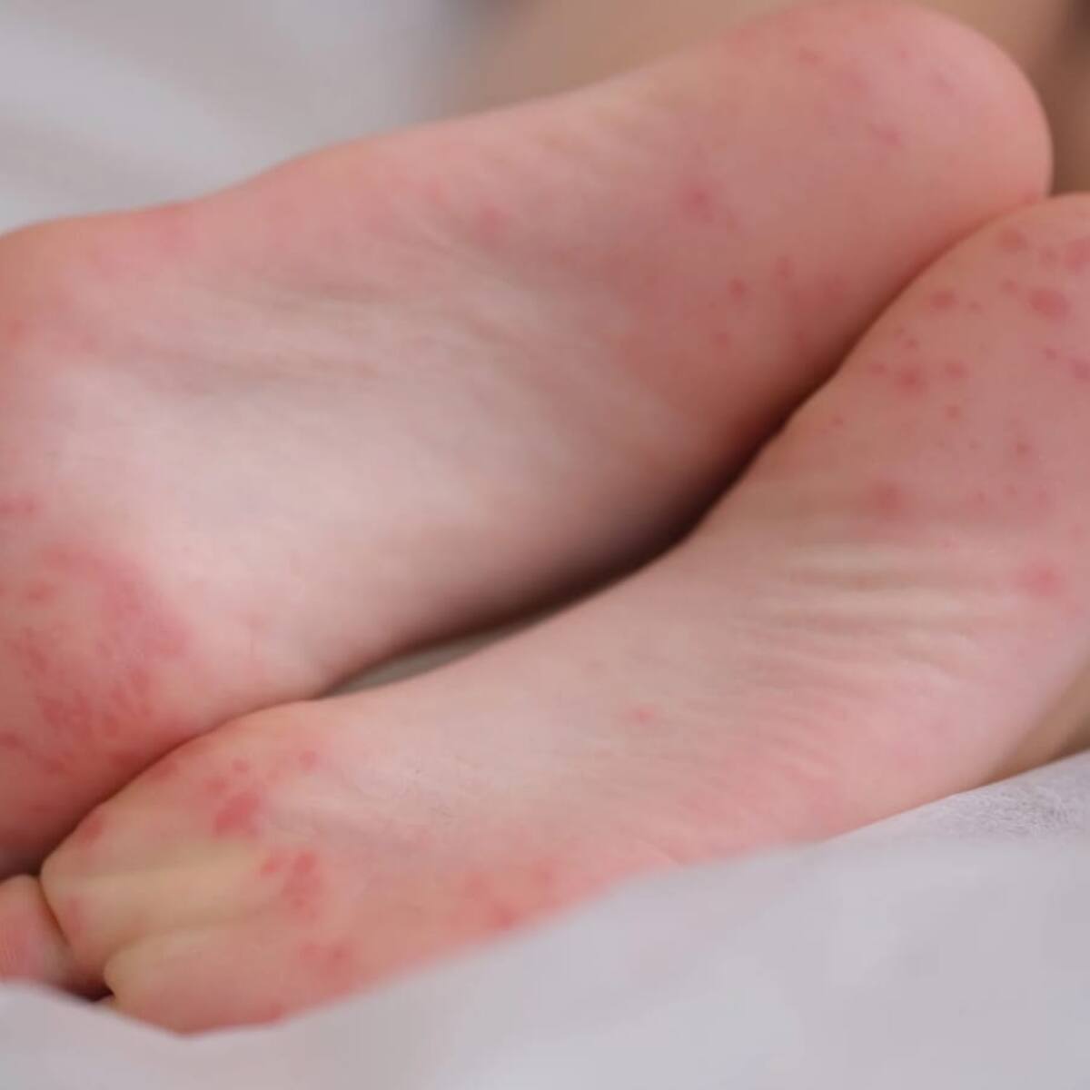 En Armenia hay brote del síndrome de boca-mano-pie, 64 casos confirmados en menores de edad