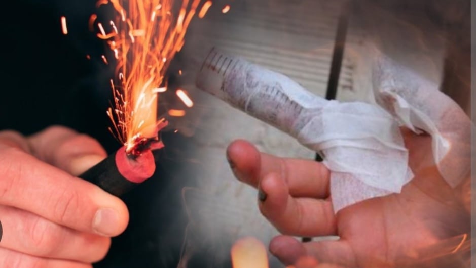 Quemados por pólvora / Foto: Archivo