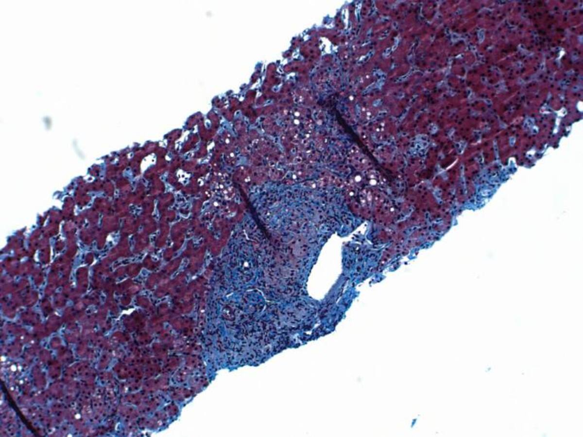 Hepatitis - 14 de enero