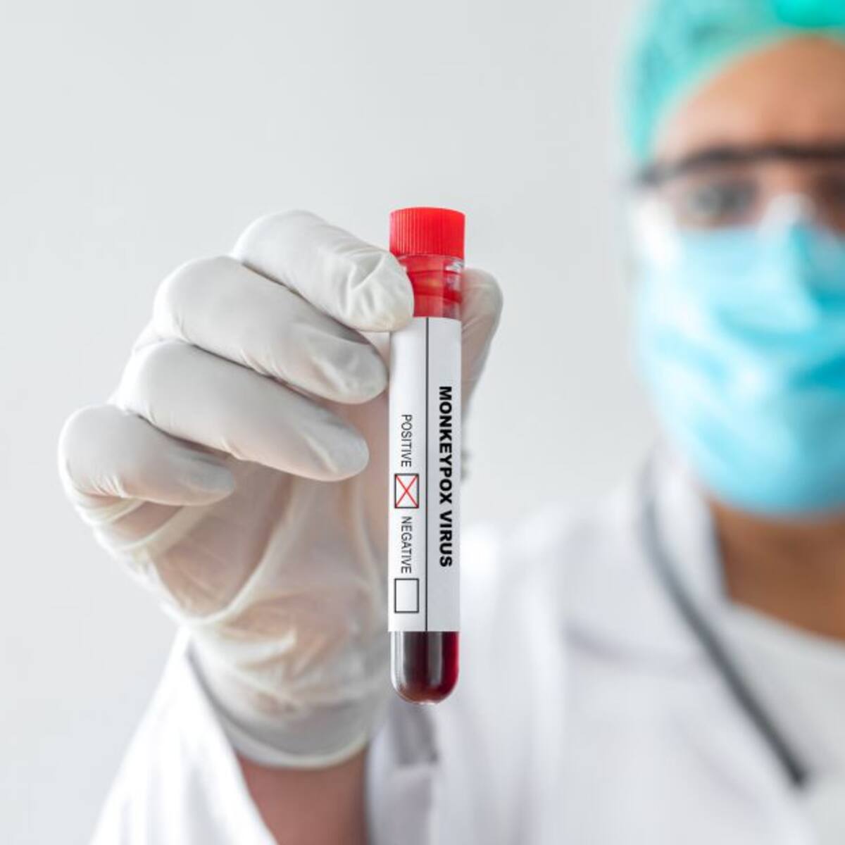 Viruela del mono en Colombia: contagios, cómo se transmite y gravedad