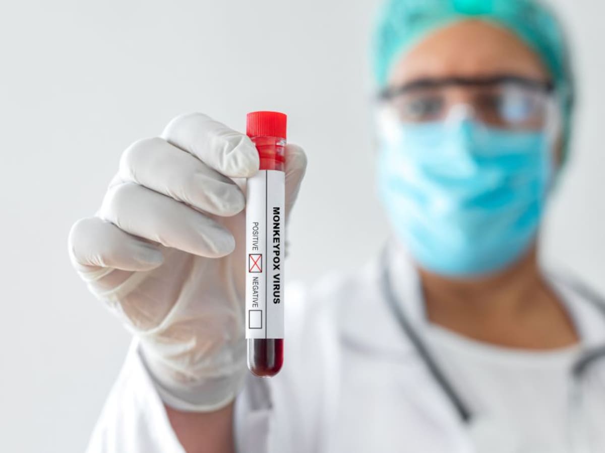 Viruela del mono en Colombia: contagios, cómo se transmite y gravedad