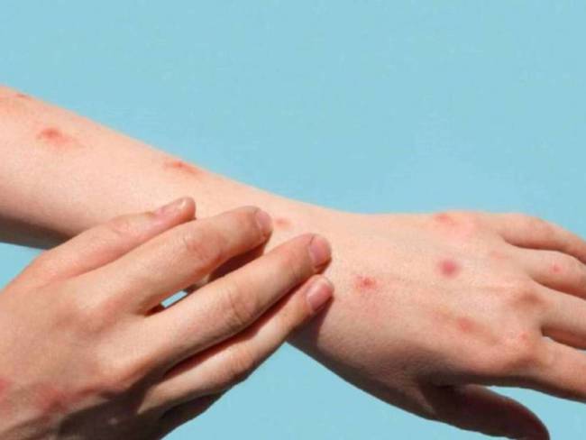 Viruela del mono en Pereira- Getty Images.