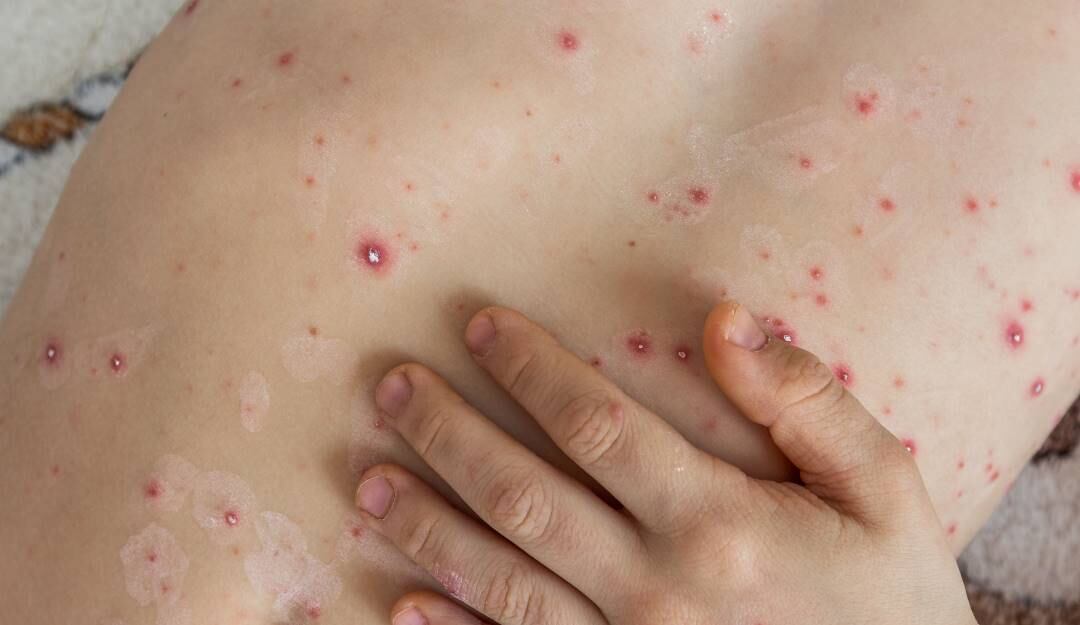 Expertos aclaran que la viruela no es una enfermedad de transmisión sexual. Foto: Getty Images.