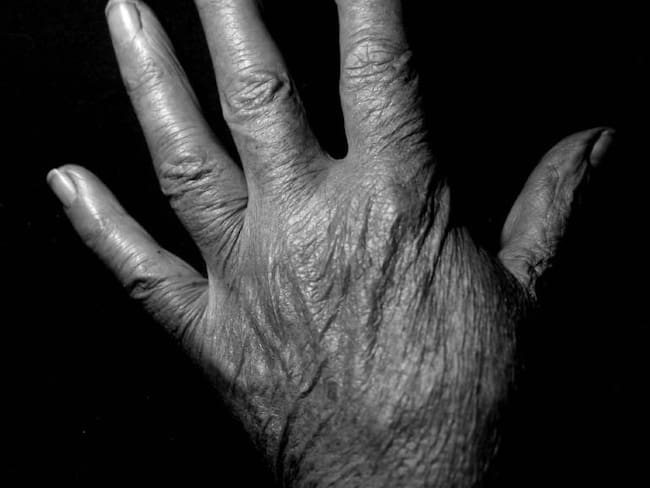 Artritis, una enfermedad que impacta mucho más que una articulación