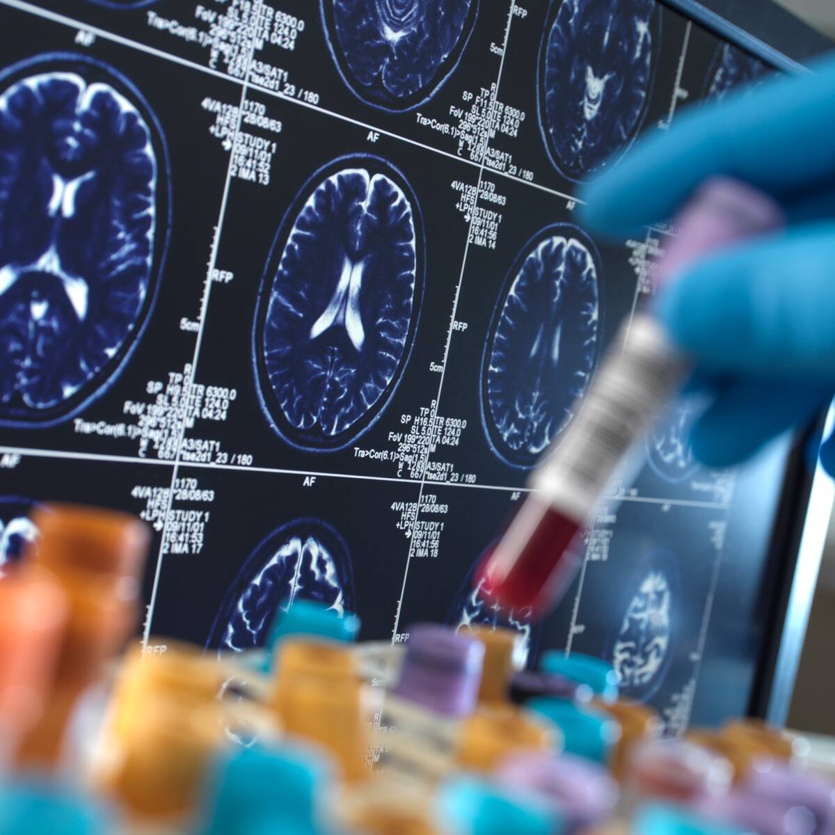 Científicos de Cuba y Colombia en EE. UU. hallan sustancia que podría detectar temprano el alzhéimer