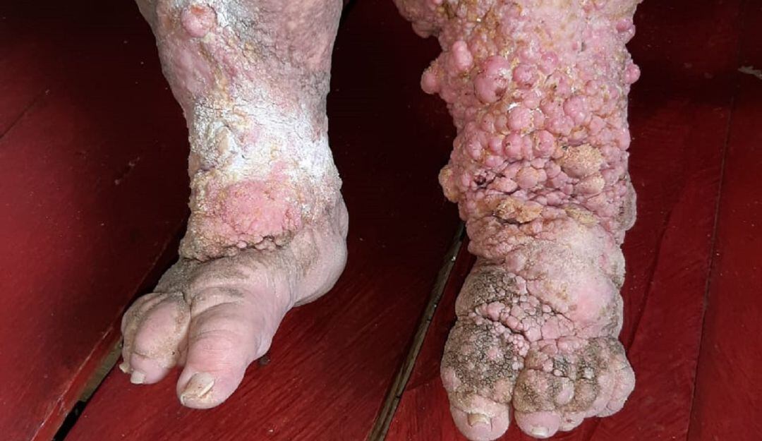 Paciente afectada por elefantiasis