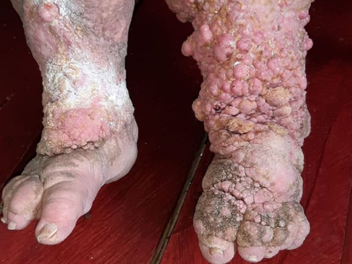 Drama para mujer afectada con elefantiasis en Samaná