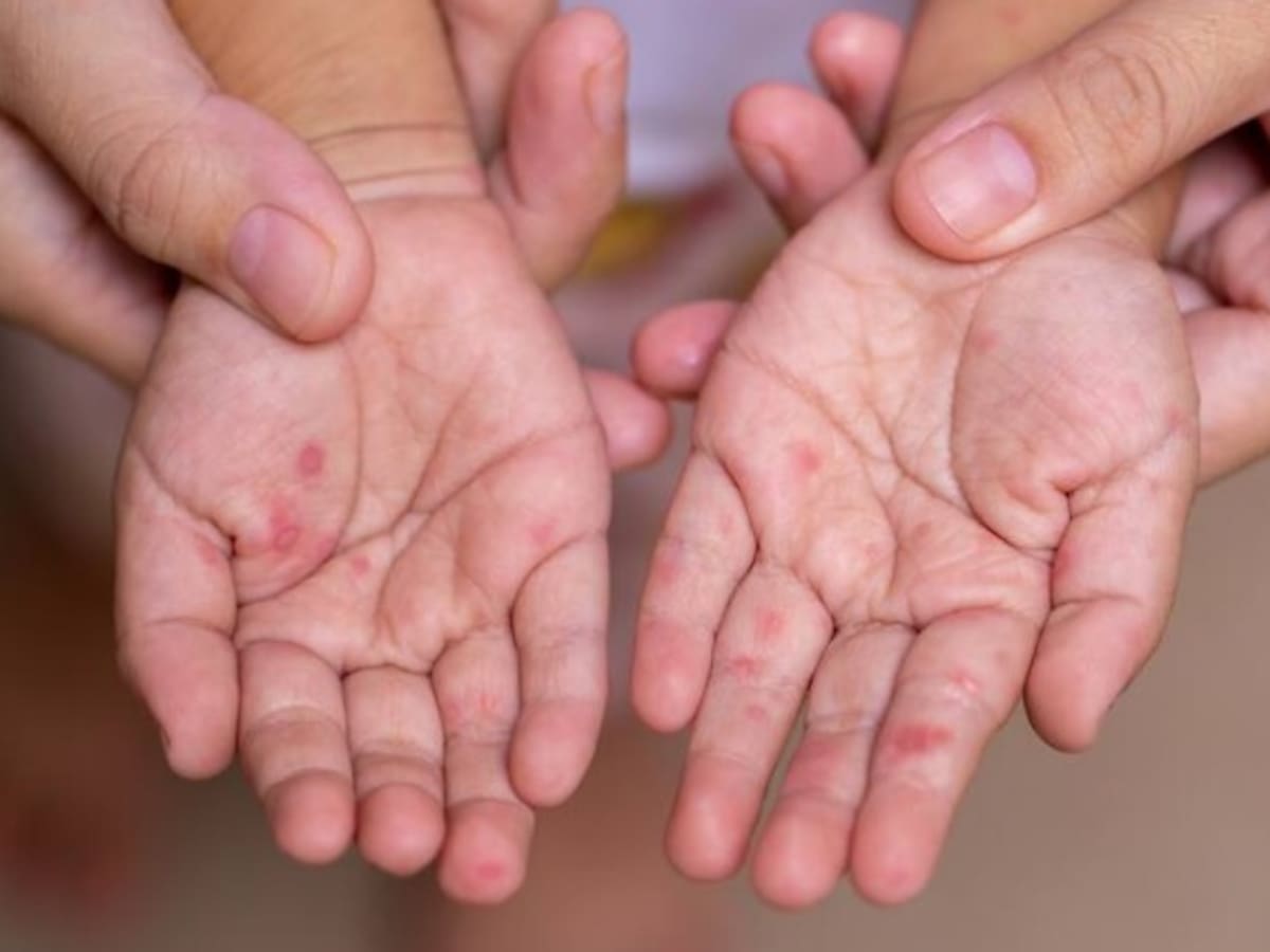 En Pereira y Dosquebradas continúa la alerta frente a casos de enfermedad mano-pie-boca