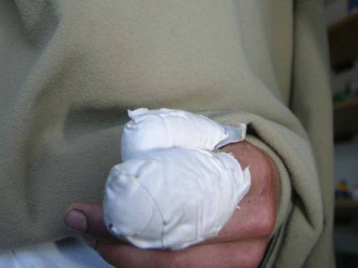 En un 55% ha disminuido los casos de menores quemados con pólvora en Cundinamarca