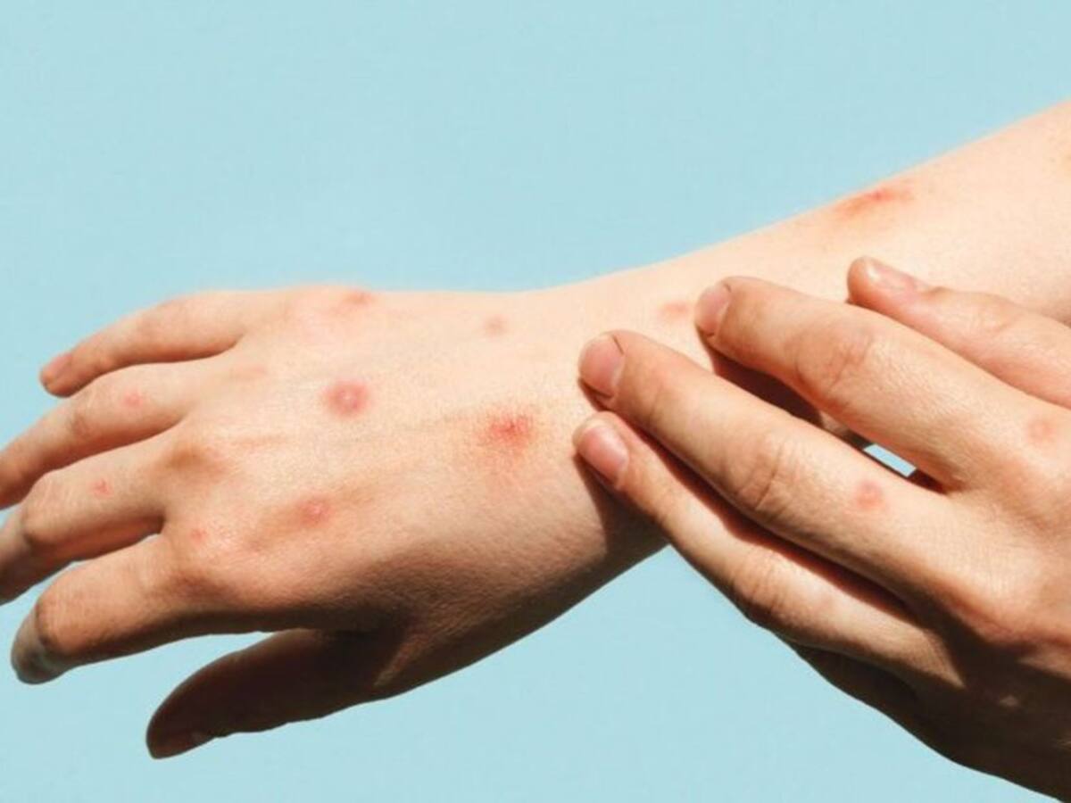 Ibagué llegó a los 14 casos confirmados de Viruela Símica