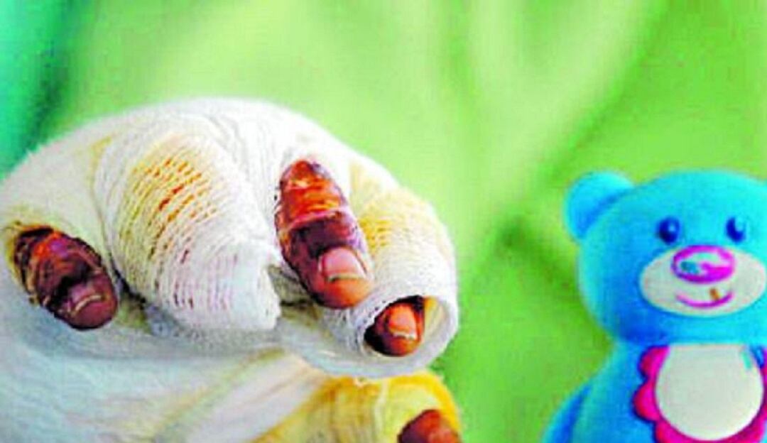 Personas quemadas en Norte de Santander