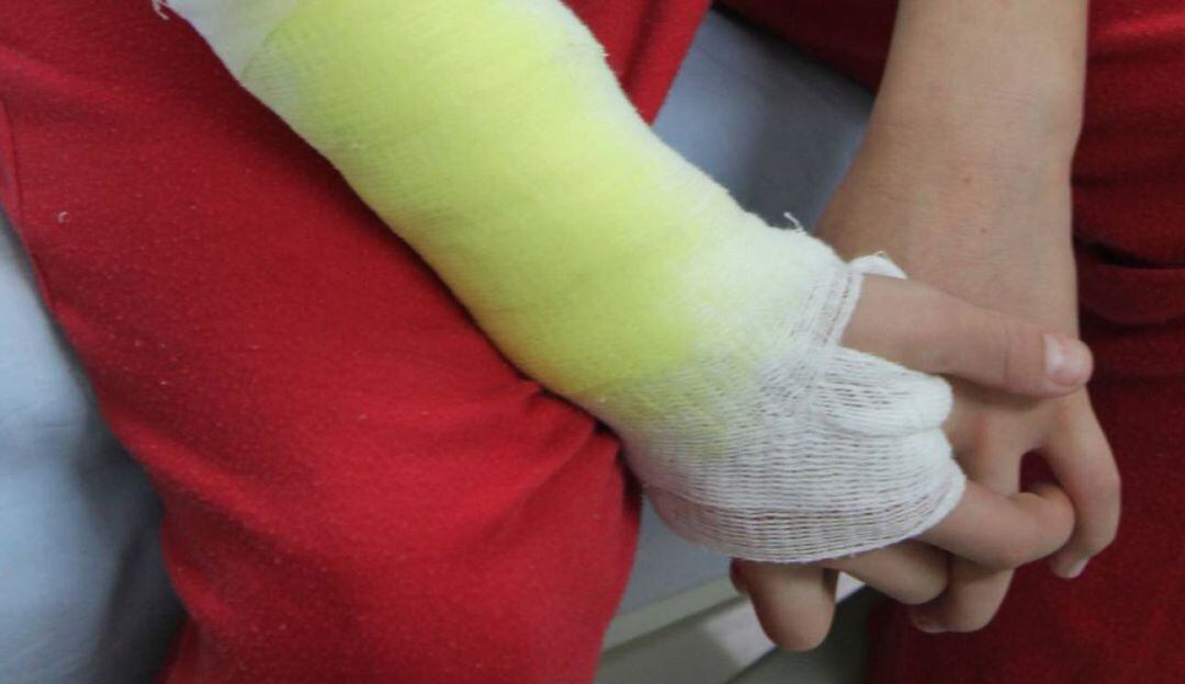 Quemado con Pólvora