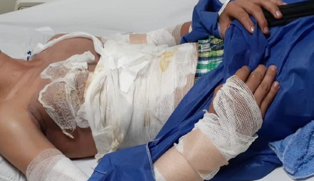 Hombre quemado en el Tolima/Imagen de Referencia