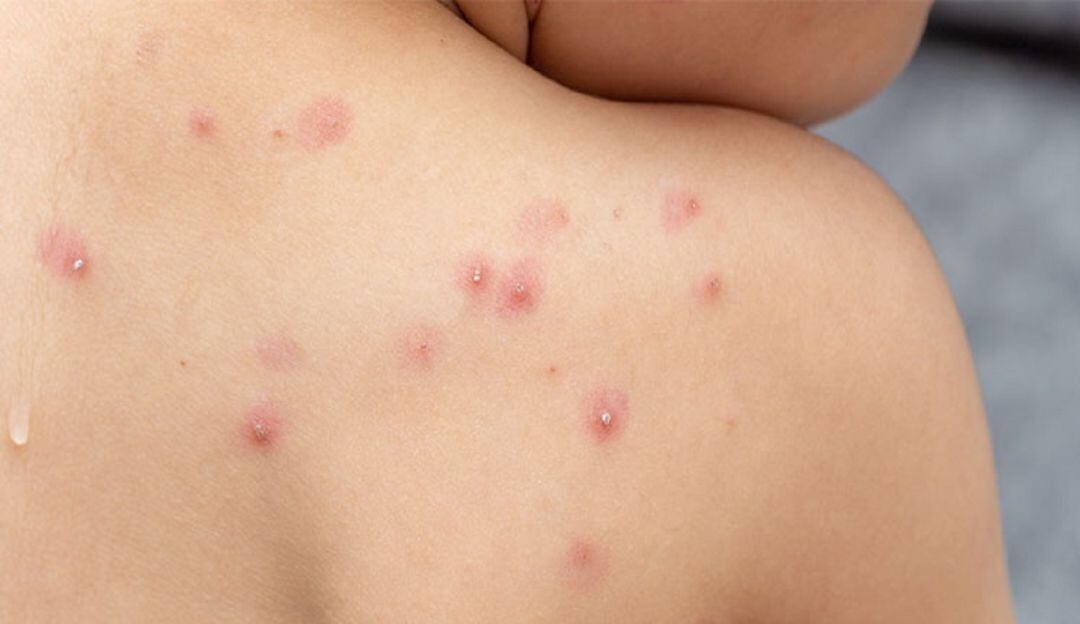 Autoridades esperan resultados por caso sospechoso de viruela del mono