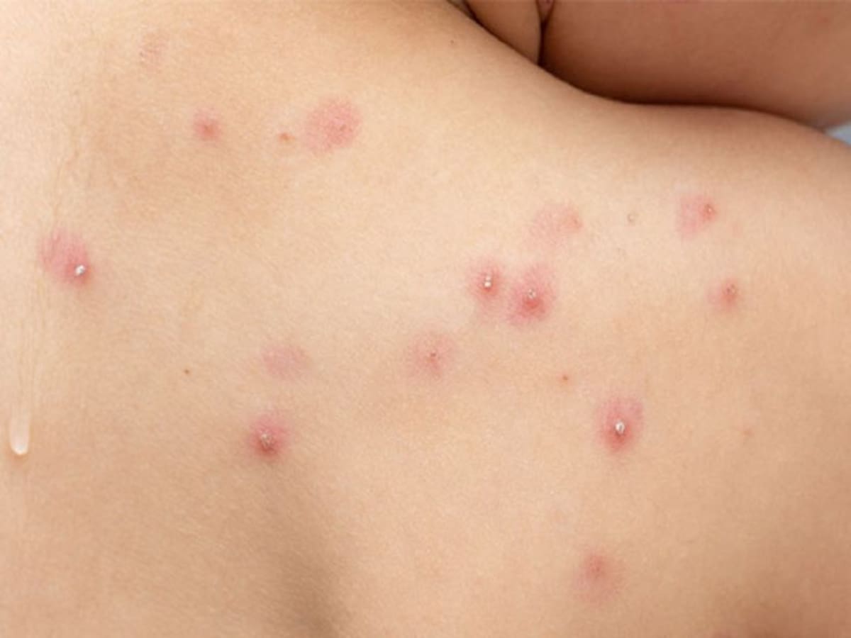 Autoridades esperan resultados por caso sospechoso de viruela del mono