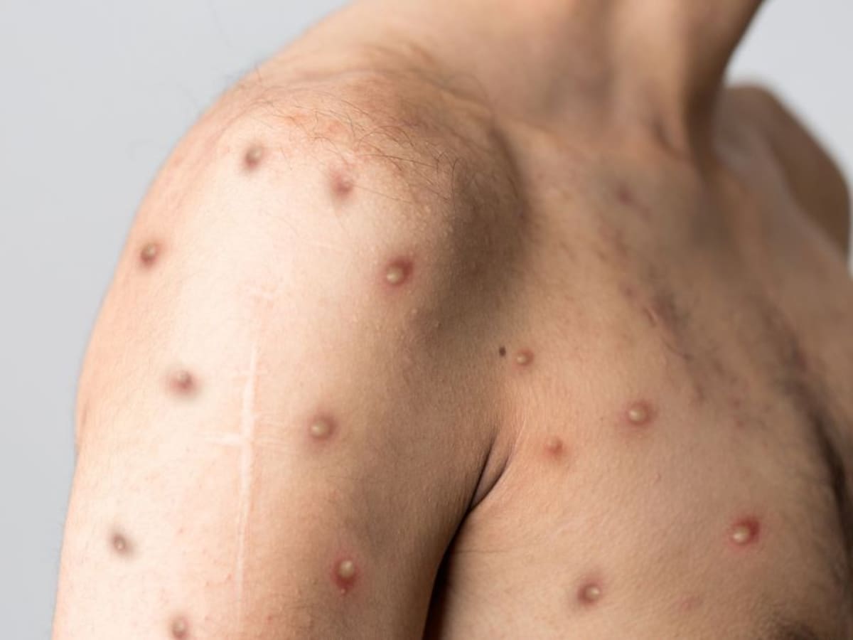 Europa comenzó a recibir vacunas contra la viruela del mono