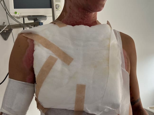 Ibagué registró tres quemados con pólvora durante la celebración de Navidad