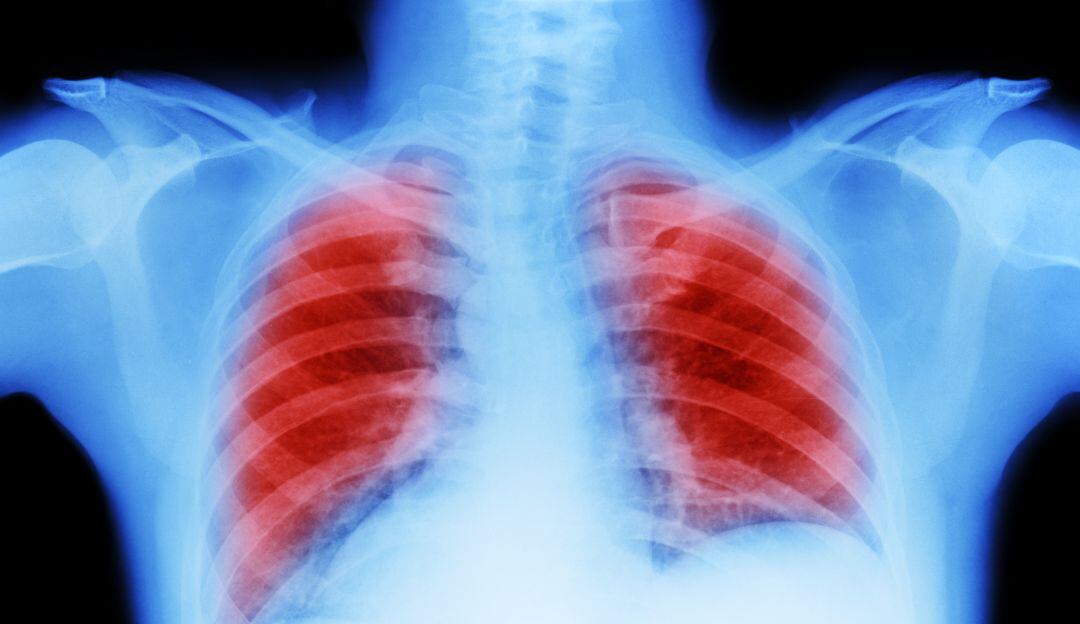 Enfoque contra cáncer de pulmón reduce tumores en 38% de los pacientes