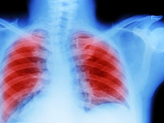 Enfoque contra cáncer de pulmón reduce tumores en 38% de los pacientes