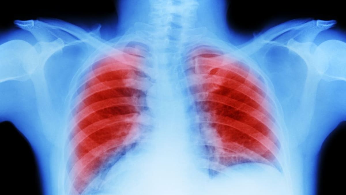 Enfoque contra cáncer de pulmón reduce tumores en 38% de los pacientes