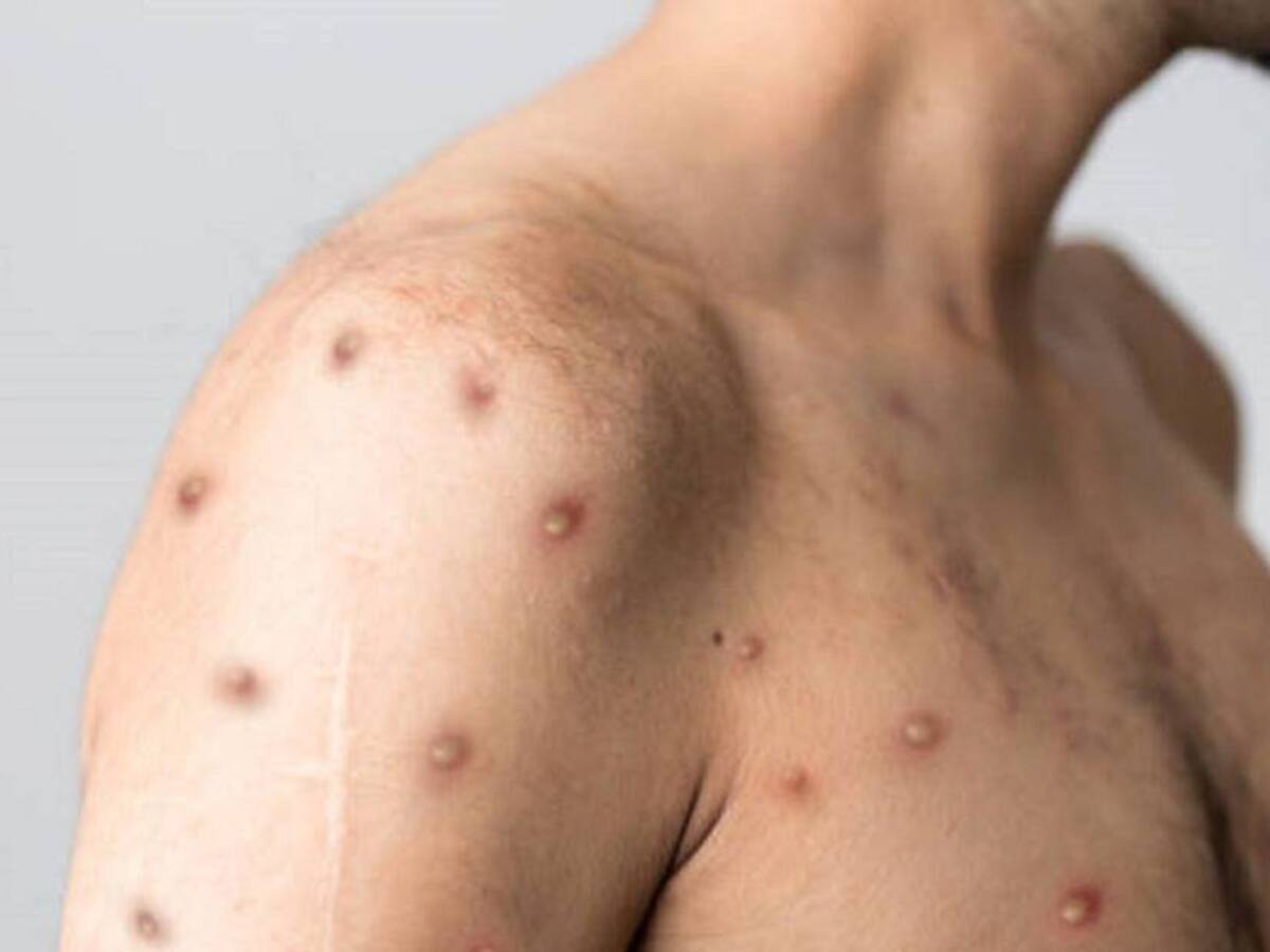 Van tres casos positivos de viruela del mono en el Huila