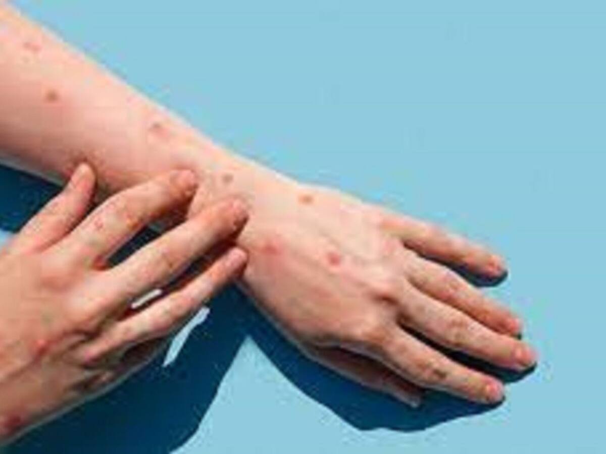 Primer caso de la viruela del mono se reporta en Ibagué