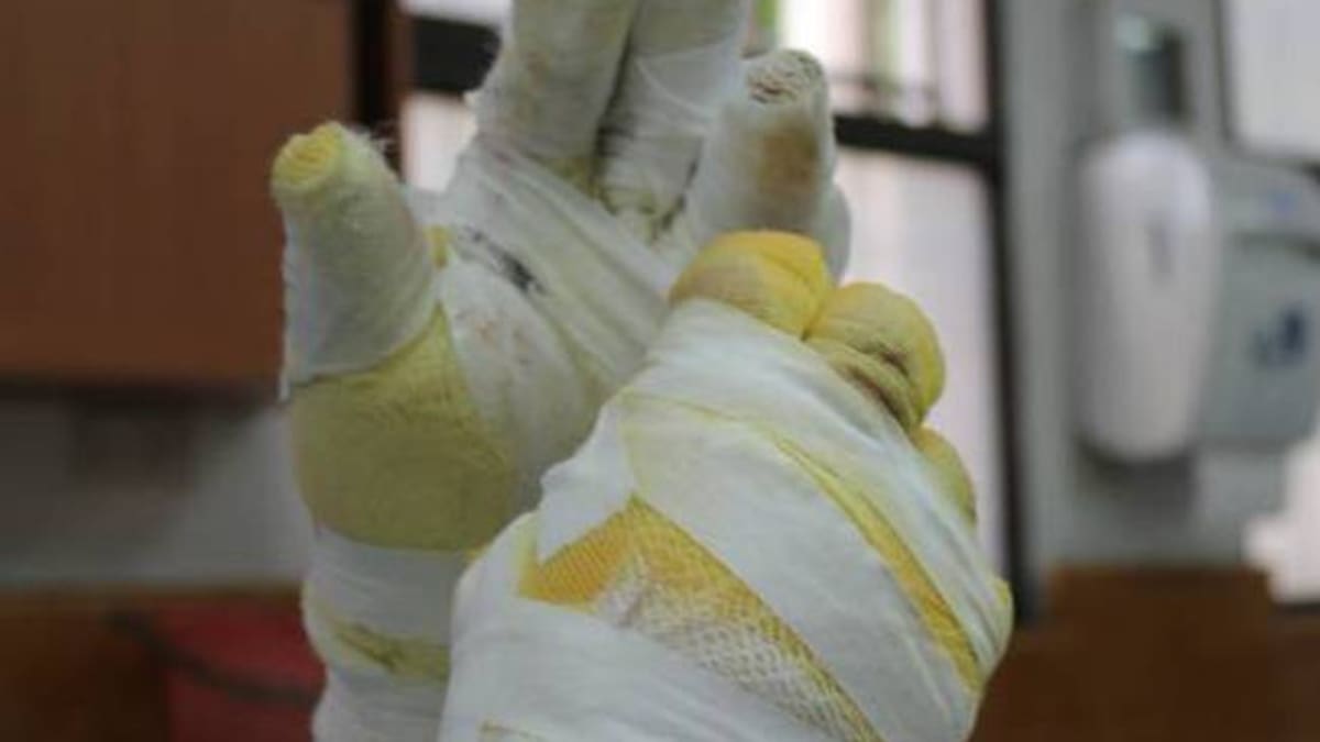 Aumenta a 64 los casos de personas quemadas con pólvora en Norte de Santander