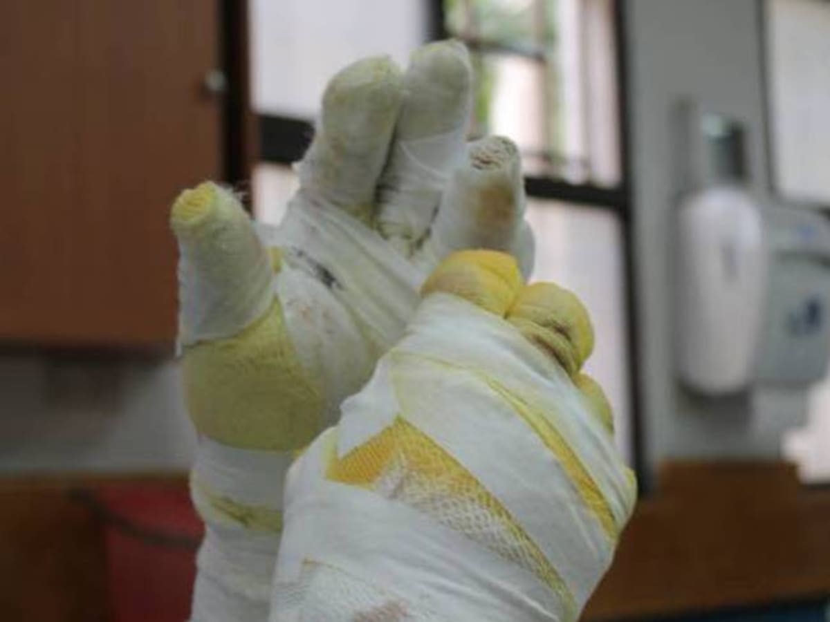 De los 9 quemados con Pólvora en Quindío, 3 atendidos en hospital San Juan de Dios