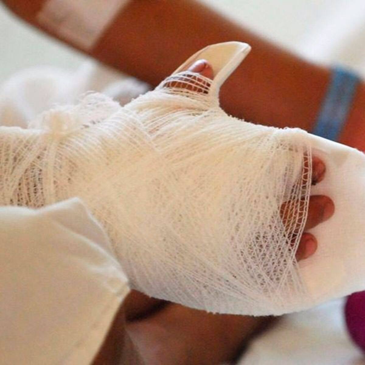 Una menor de 11 meses entre los dos quemados con pólvora en el Huila