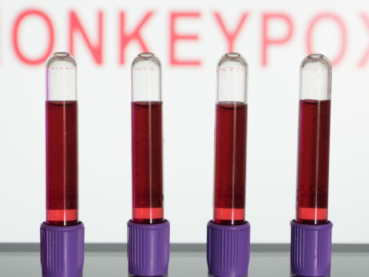 Viruela del mono: INS confirma 3 casos en Bogotá y Medellín