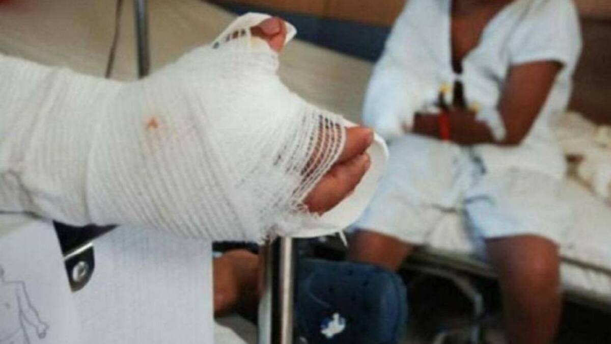 Quinto quemado con pólvora en Risaralda durante el mes de diciembre