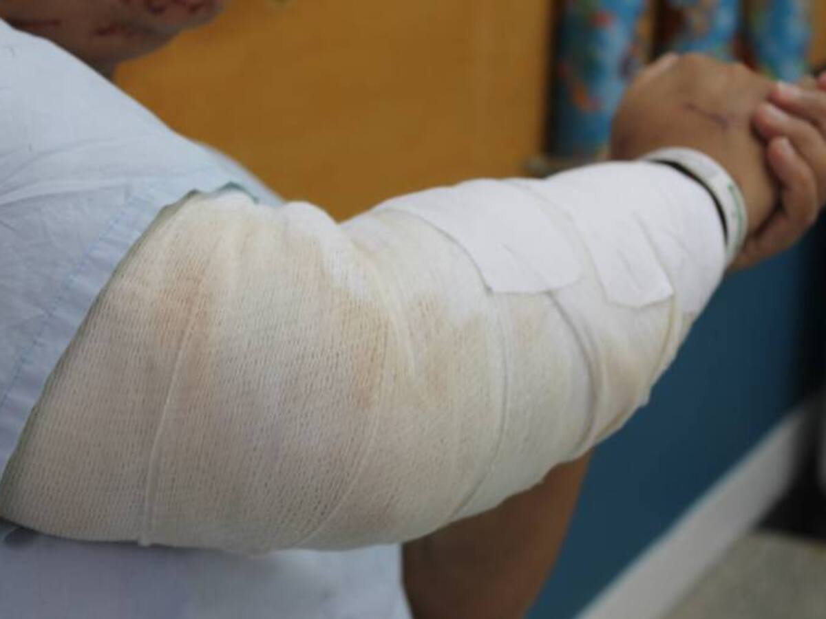 ICBF en Antioquia abre primer proceso por menores quemados con pólvora