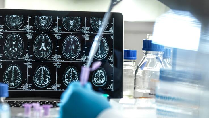 Leqembi, aprobado por la FDA para combatir el Alzheimer, ¿qué tan efectivo es?