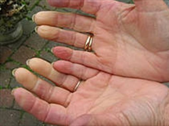 Ansiedad y estrés intensifican fenómeno de Raynaud