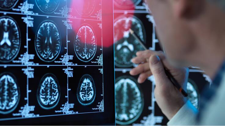 Científicos desarrollan análisis de sangre para detectar el Alzhéimer con 90% de precisión