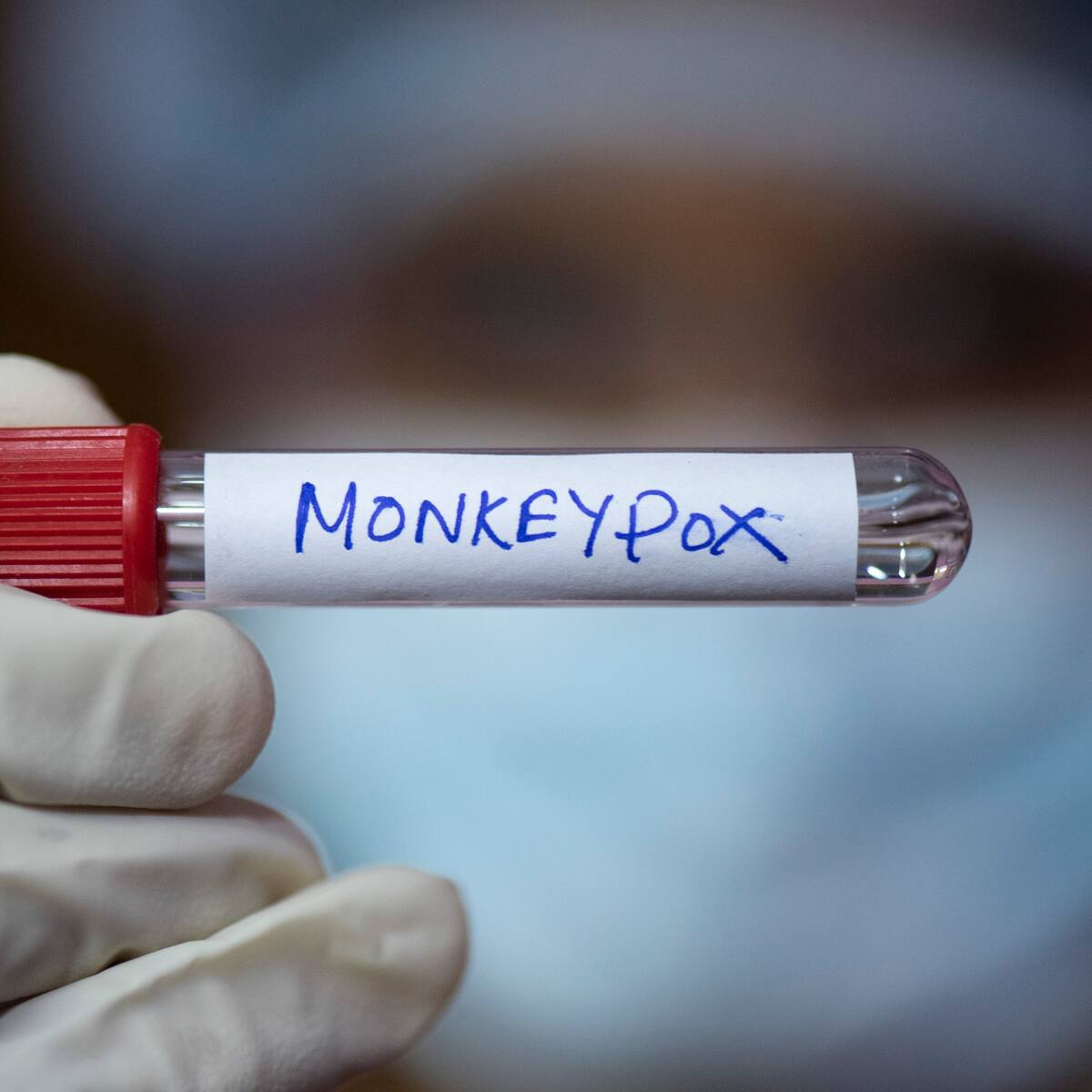 Mpox: OMS mantiene emergencia internacional por aumento de casos en África