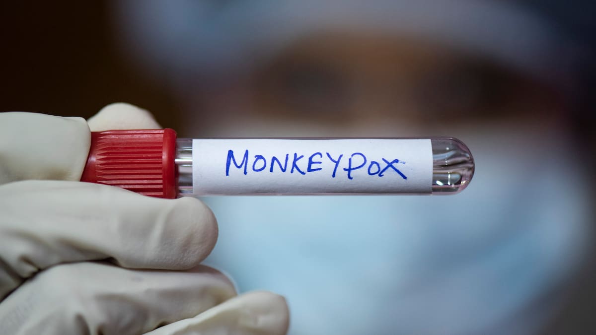 Mpox o viruela del mono, ¿cómo se contagia y cuáles son sus síntomas?