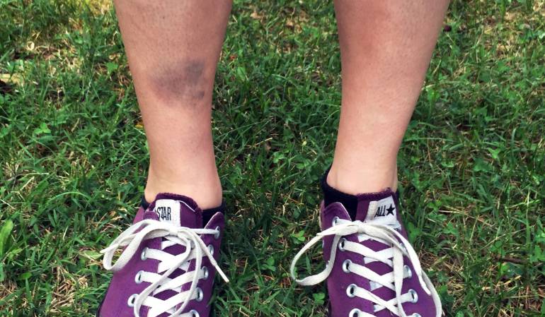 Lindsay Plunkett, camarera de 23 años en Asheville, Carolina del Norte, muestra el golpe que recibió después de tropezar con un bloque de concreto por ir jugando Pokemon Go con su teléfono celular.