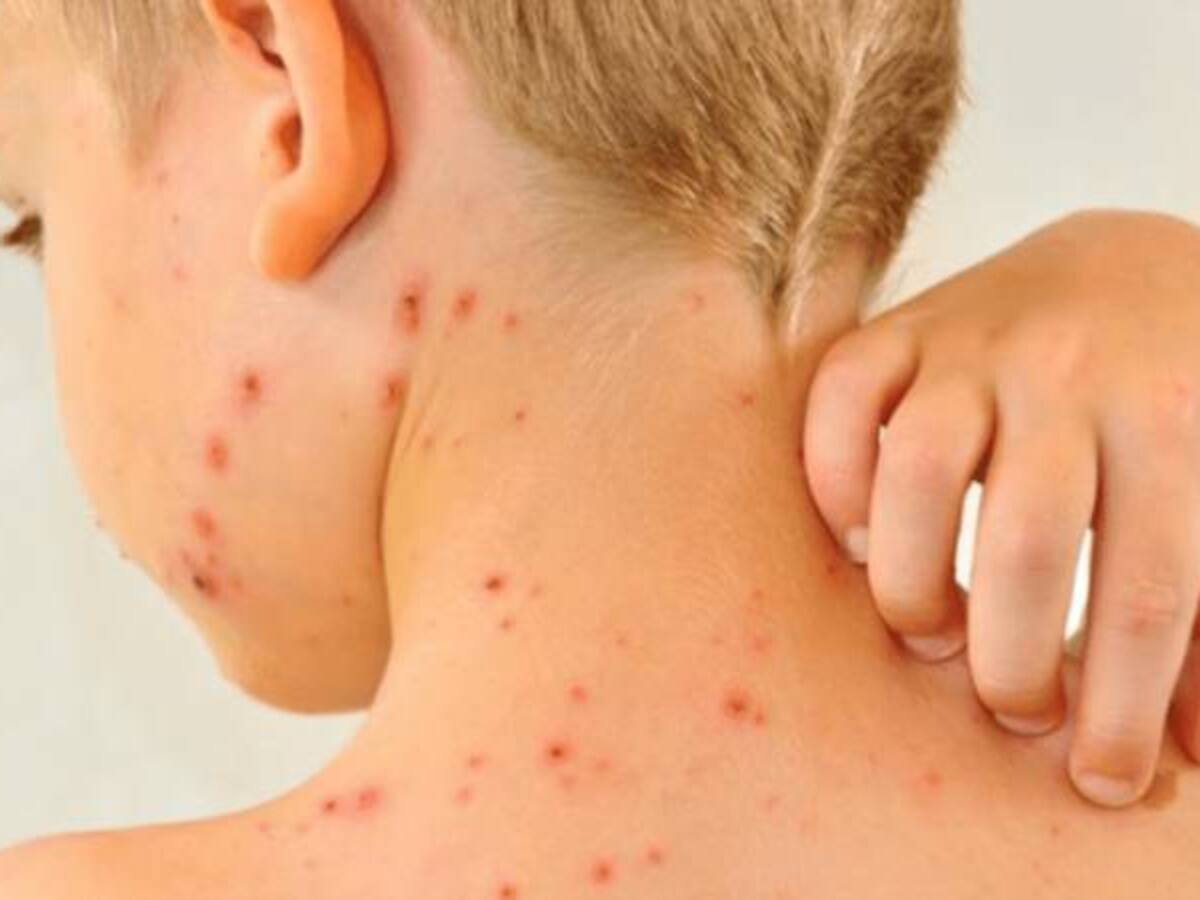 MinSalud confirma quinto caso de sarampión en Cartagena