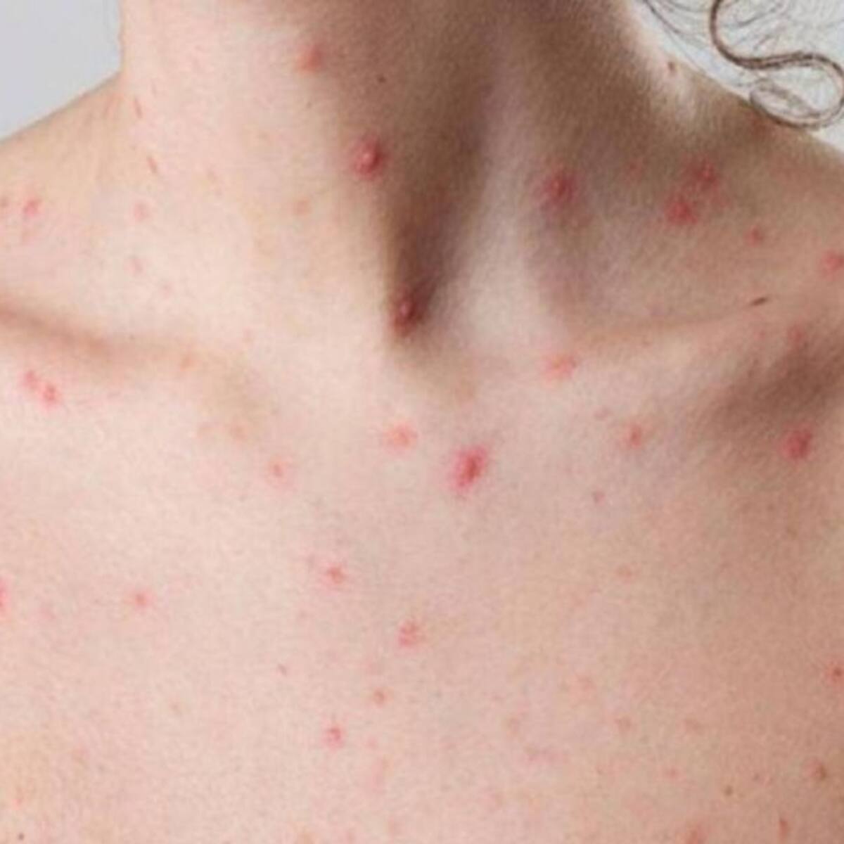 Inició la fase de contención de la viruela del mono en Risaralda