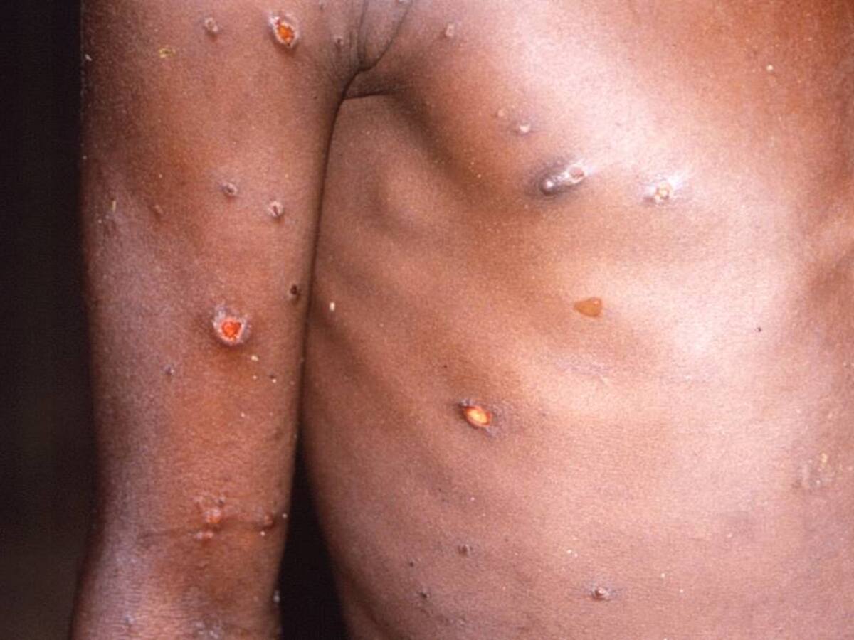 La viruela del mono llegó a Argentina y es el primer caso en A. Latina