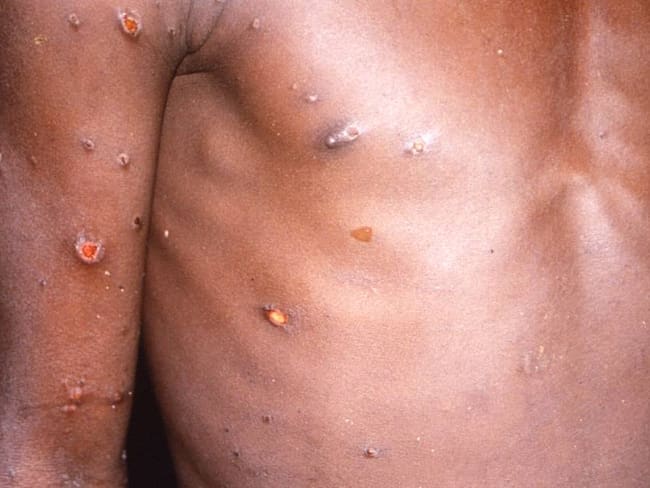Heridas en la piel tras contagio con la viruela del mono.          Foto: Getty 